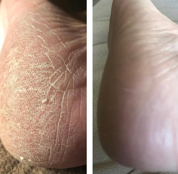 Epoch Sole Solution Foot Treatment - Summer at Payton's Online Boutique